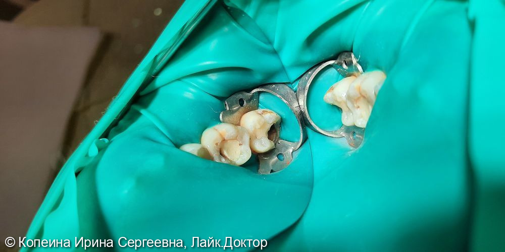 Необратимый пульпит зуба 3.7, разрушенность коронки более 50% - фото №1