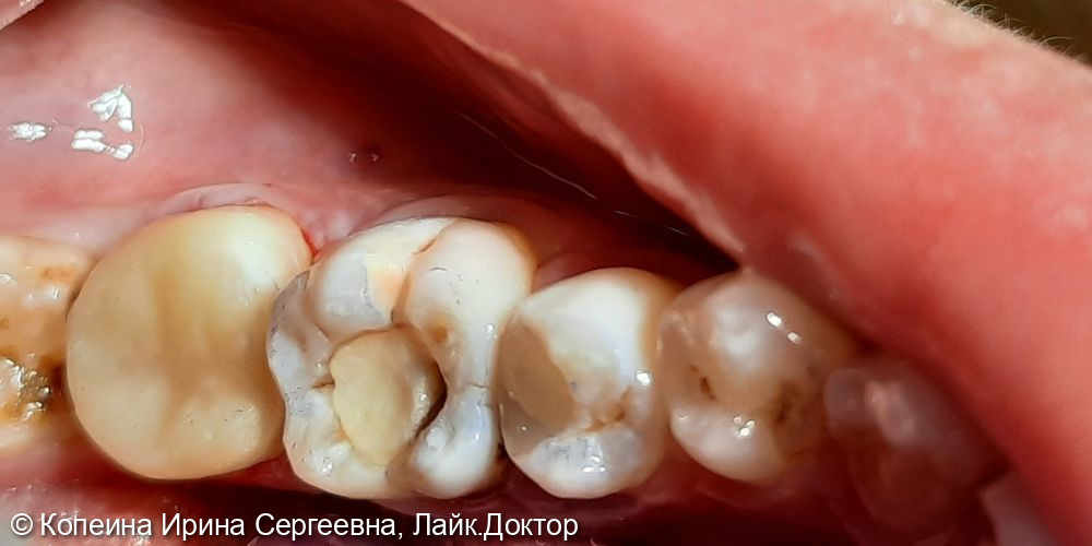 Необратимый пульпит зуба 3.7, разрушенность коронки более 50% - фото №2