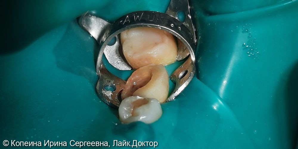 Лечение пульпита зуба 3.6 - фото №1