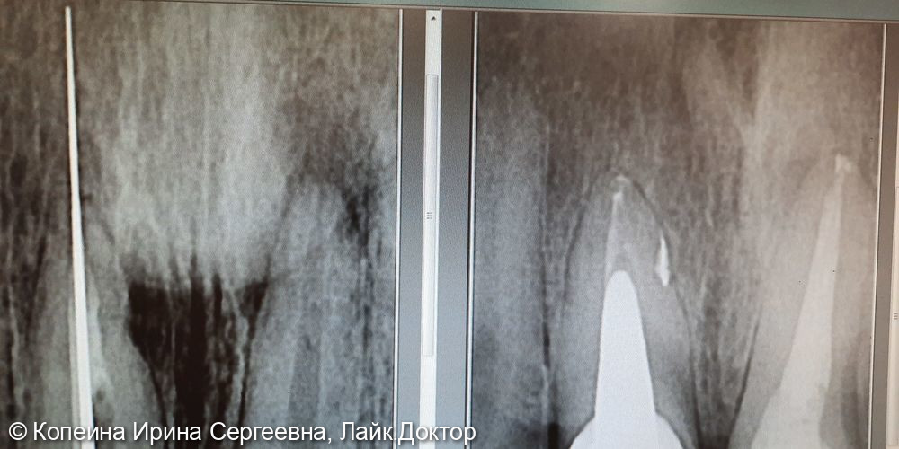 Лечение периодонтита зубов 1.1 и 2.1 - фото №1