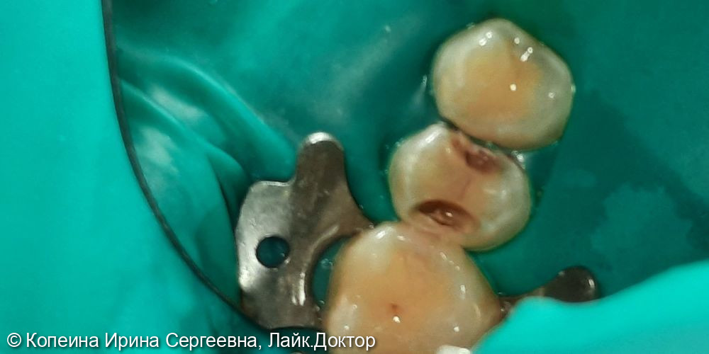 Лечение хронического пульпита зуба 2.5 - фото №1