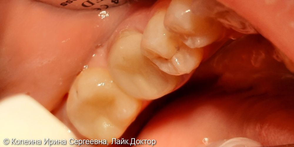 Лечение кариеса зуба 3.7 - фото №2