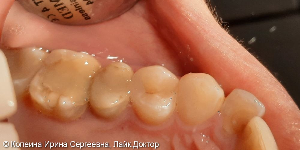 Лечение кариеса зубов 2.3, 2.4 - фото №2