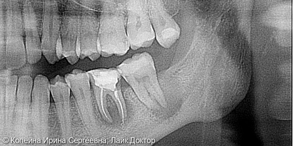 Лечение периодонтита зуба 3.7 - фото №1