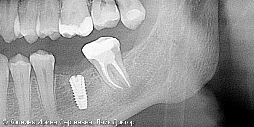 Лечение периодонтита зуба 3.7 - фото №2