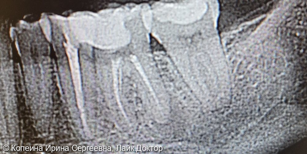 ревизия корневых каналов зуба 3.6 - фото №1