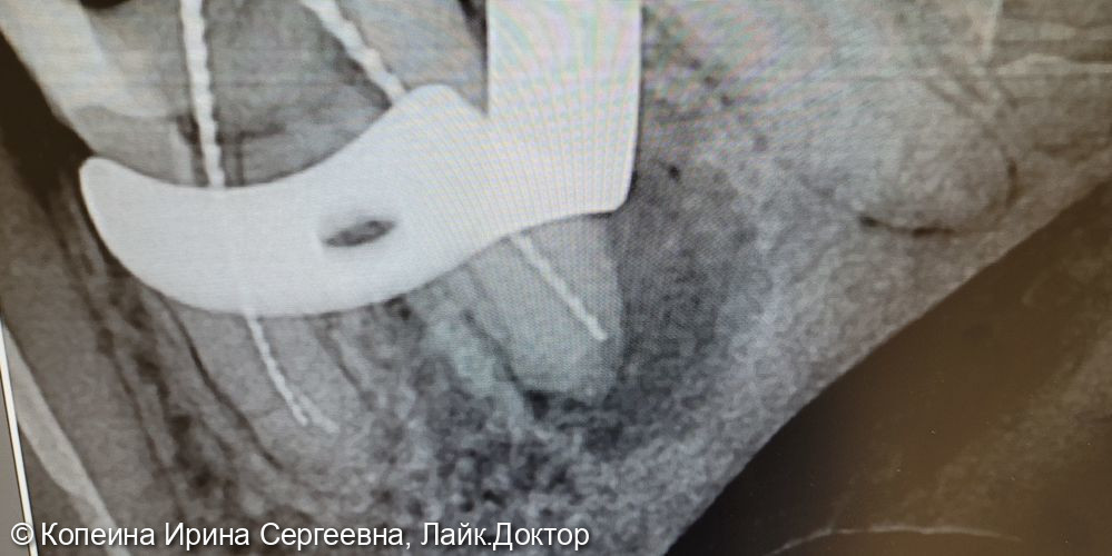 ревизия корневых каналов зуба 3.6 - фото №2