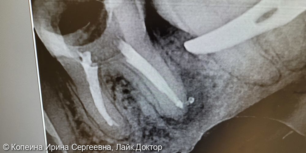 ревизия корневых каналов зуба 3.6 - фото №3