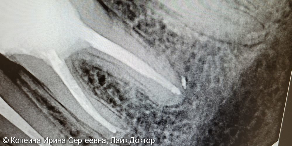 ревизия корневых каналов зуба 3.6 - фото №4