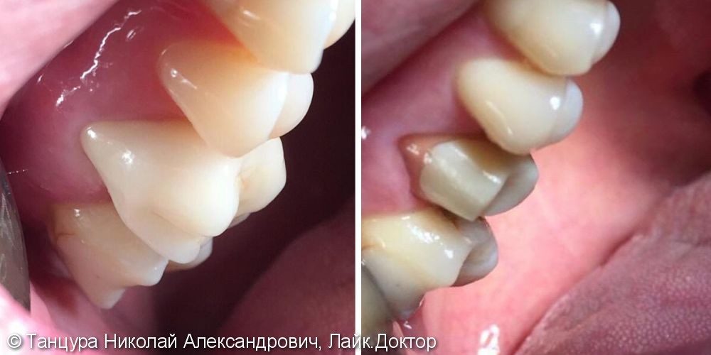 Протезирование зубов керамической коронкой - фото №1