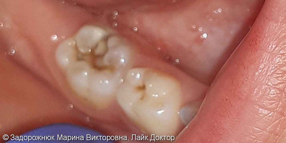 Лечение и реставрация зуба №48 фотополимером Filtek - фото №1