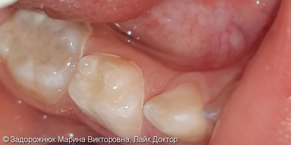 Лечение и реставрация зуба №48 фотополимером Filtek - фото №3