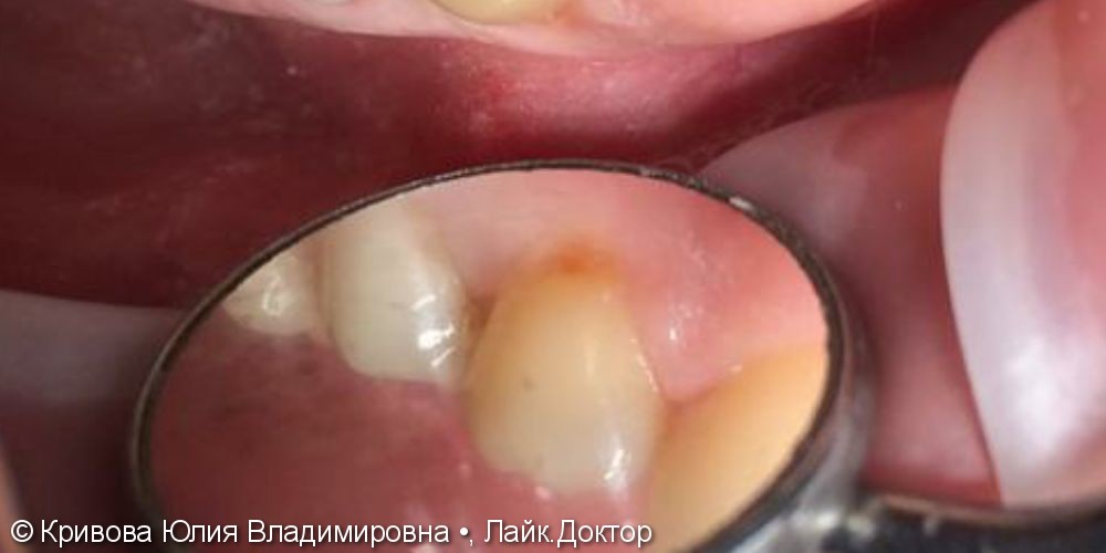 Лечение кариеса и некариозных поражений зубов - фото №1