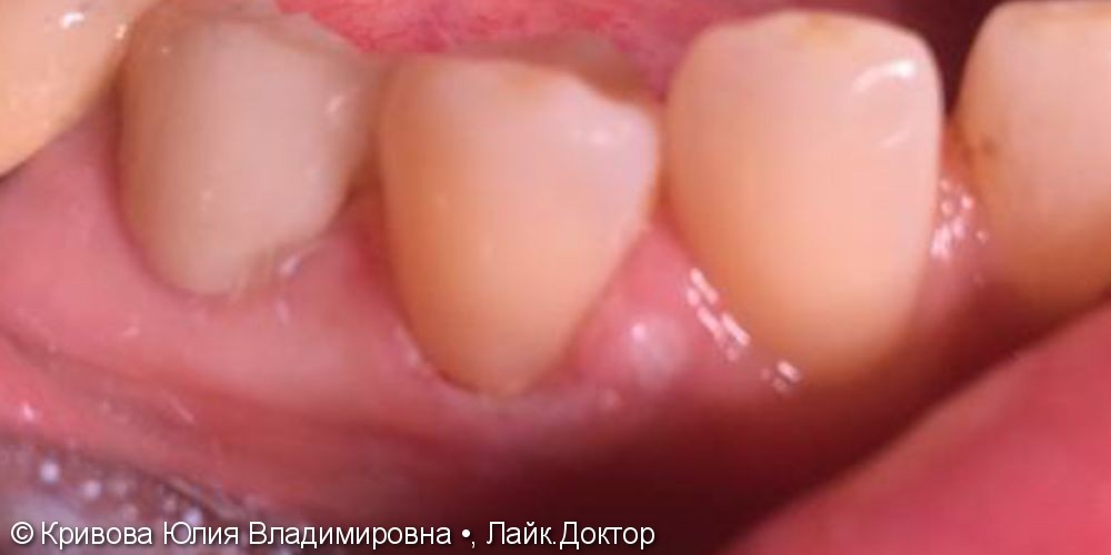 Лечение кариеса и некариозных поражений зубов - фото №2