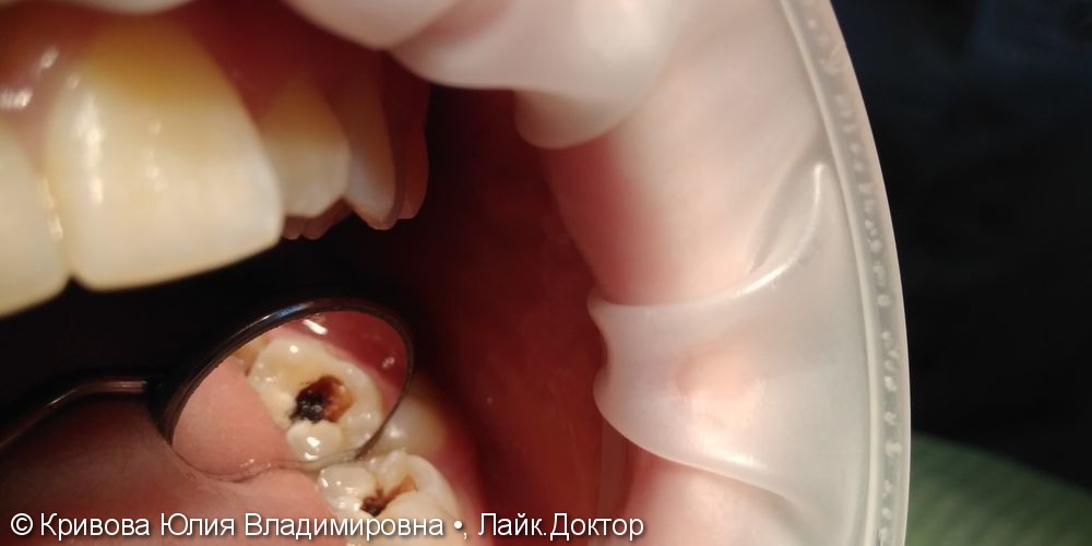 Лечение кариеса 36 зуба - фото №1