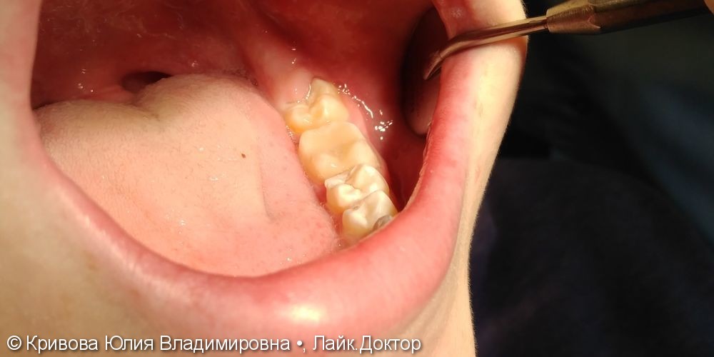 Лечение кариеса 36 зуба - фото №3
