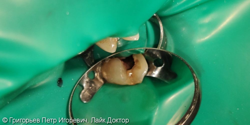 Эндодонтическое лечение зуба 2.5 при хроническом пульпите - фото №1