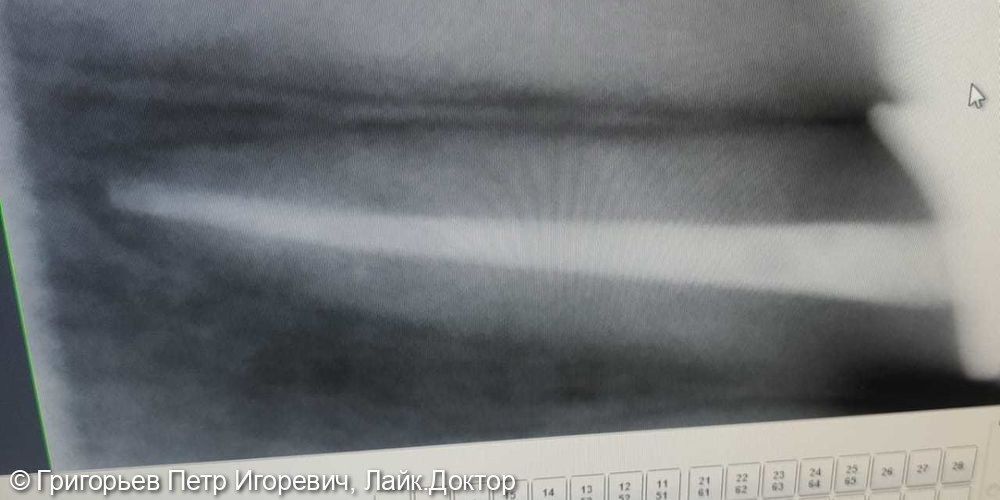 Хронический фиброзный пульпит зуб 2.2 - фото №2
