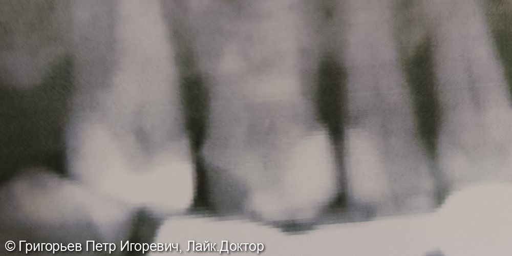 Хронический фиброзный пульпит зуб 1.6 - фото №1