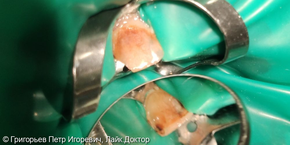 Хронический фиброзный пульпит зуб 1.1 - фото №1