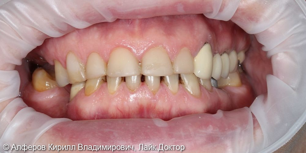 Сочетанное протезирование фронтальных и жевательных зубов - фото №1