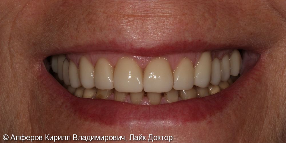 Сочетанное протезирование фронтальных и жевательных зубов - фото №3