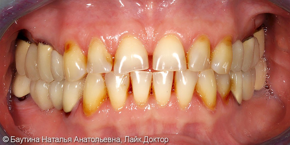 Тотальная реставрация зубного ряда - фото №1