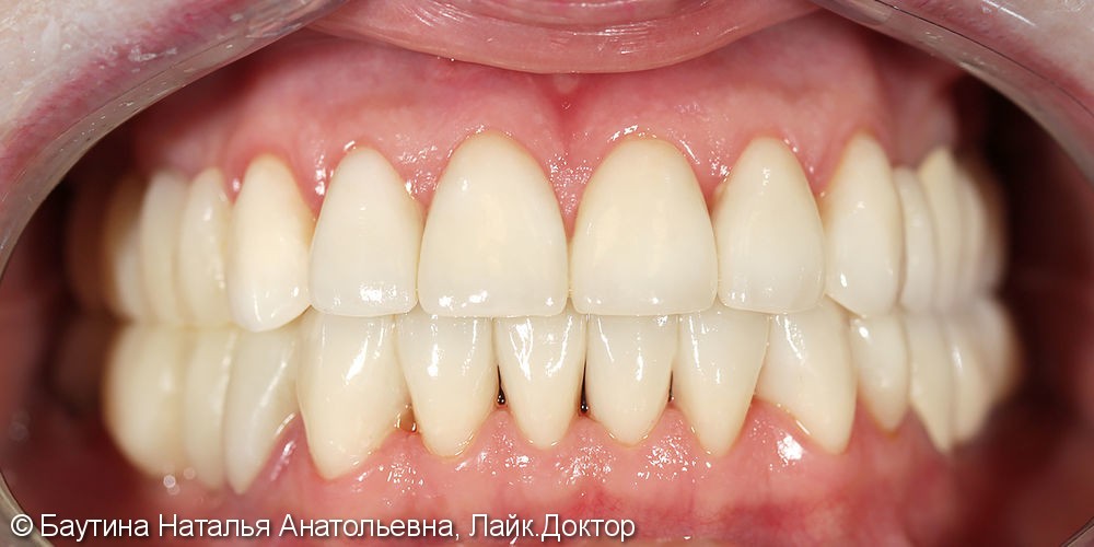 Тотальная реставрация зубного ряда - фото №2