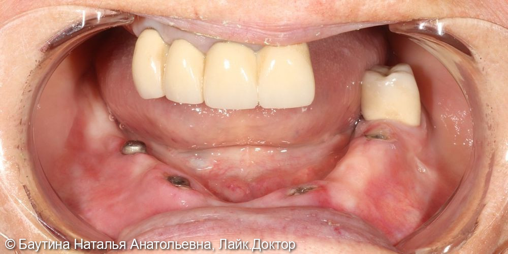Реабилитация зубного ряда у женщины 68 лет - фото №1