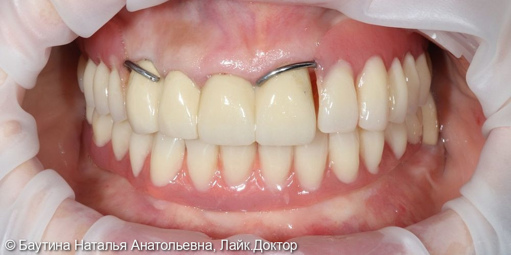 Реабилитация зубного ряда у женщины 68 лет - фото №2