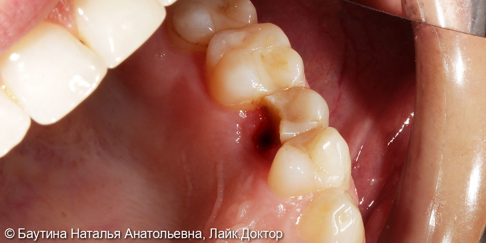 Керамическая пломба на жевательный зуб - фото №1