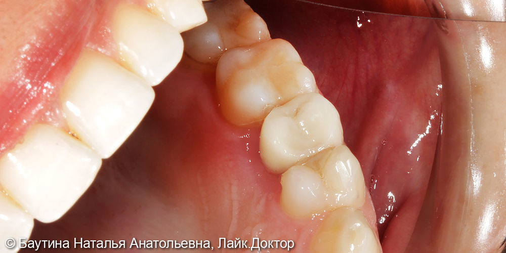 Керамическая пломба на жевательный зуб - фото №2