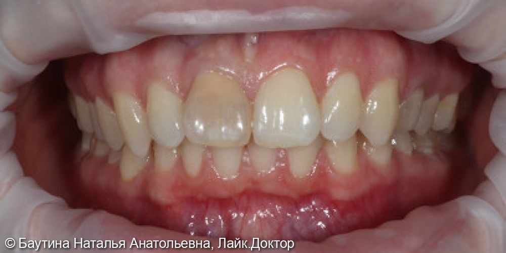 Эстетическая реставрация фронтальных зубов - фото №1