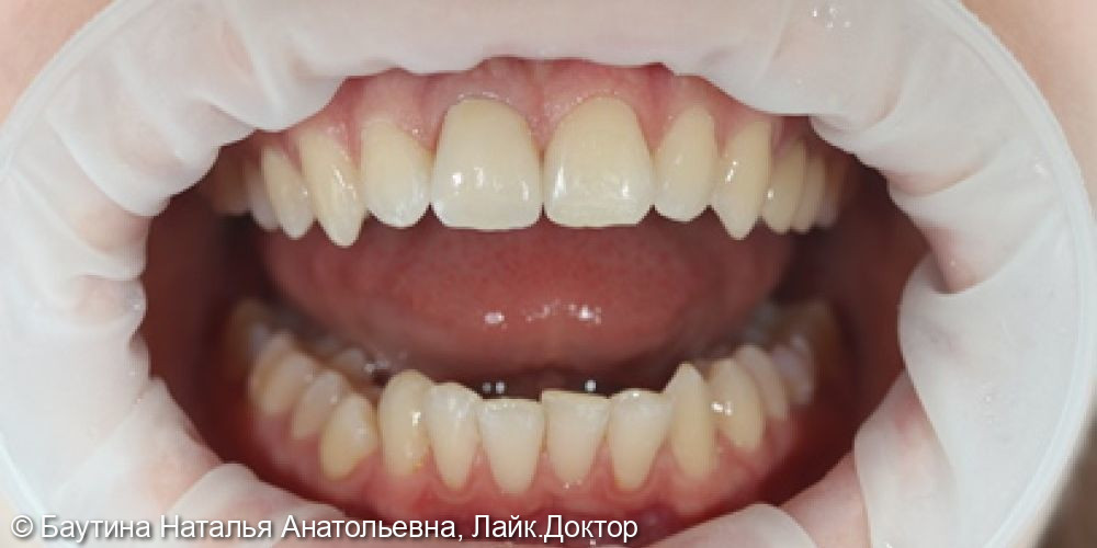 Эстетическая реставрация фронтальных зубов - фото №2