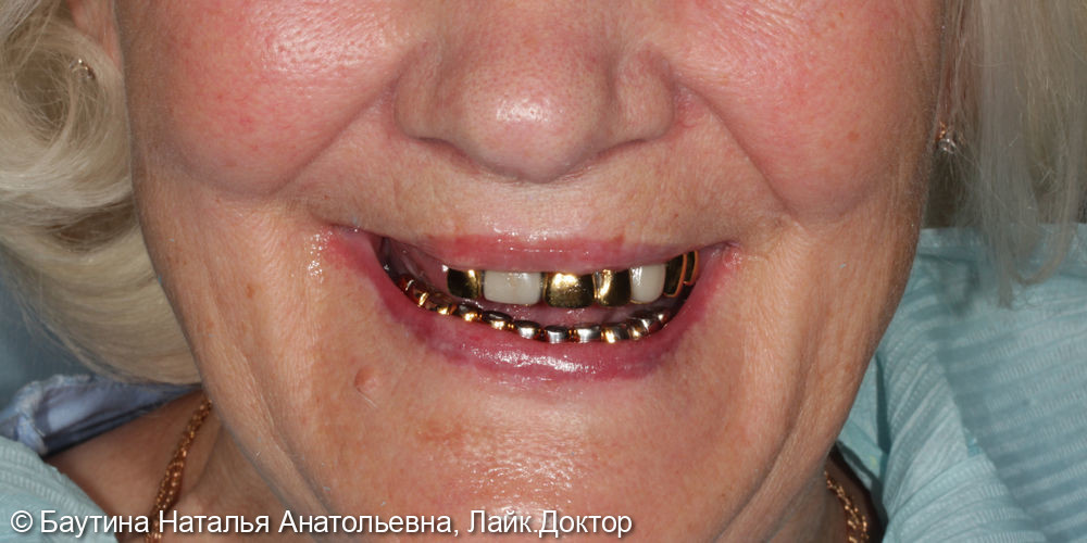 Комплексная реабилитация по технологии «Все зубы на 4-х имплантатах» - фото №1