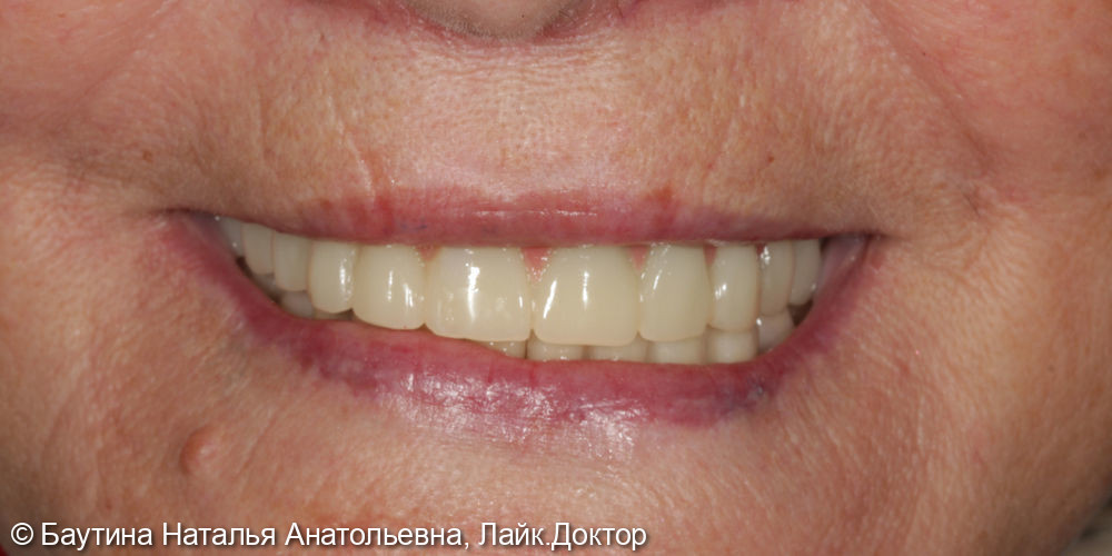 Комплексная реабилитация по технологии «Все зубы на 4-х имплантатах» - фото №9