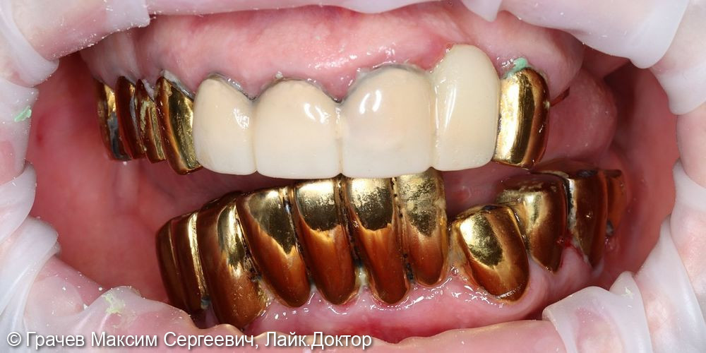 Несъемное протезирование при полном отсутствии зубов - фото №1