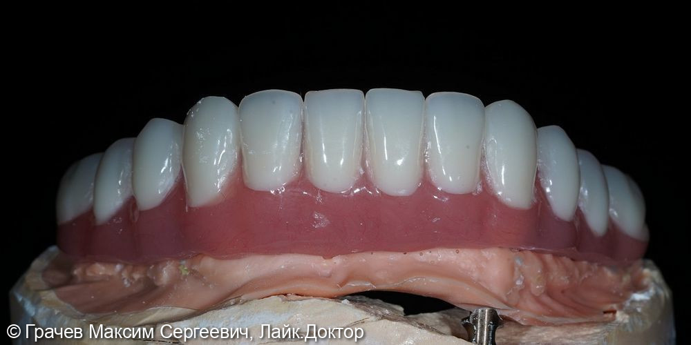 Несъемное протезирование при полном отсутствии зубов - фото №2