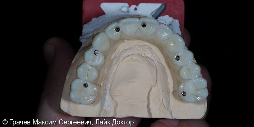 Несъемное протезирование при полном отсутствии зубов - фото №3