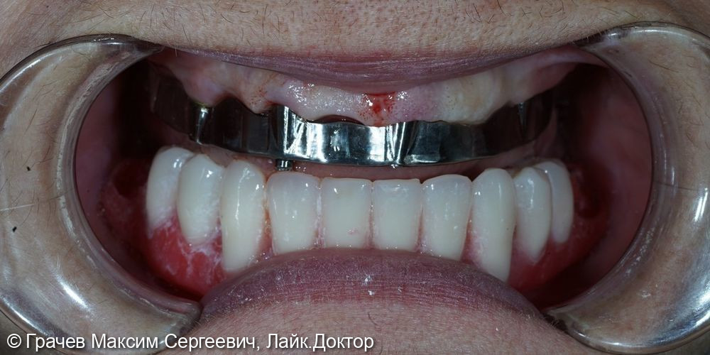Несъемное протезирование при полном отсутствии зубов - фото №4