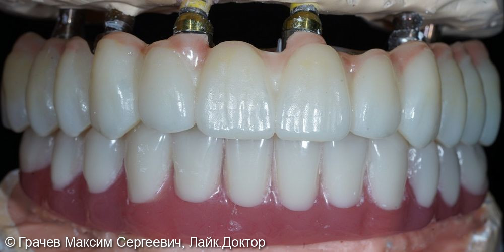 Несъемное протезирование при полном отсутствии зубов - фото №5