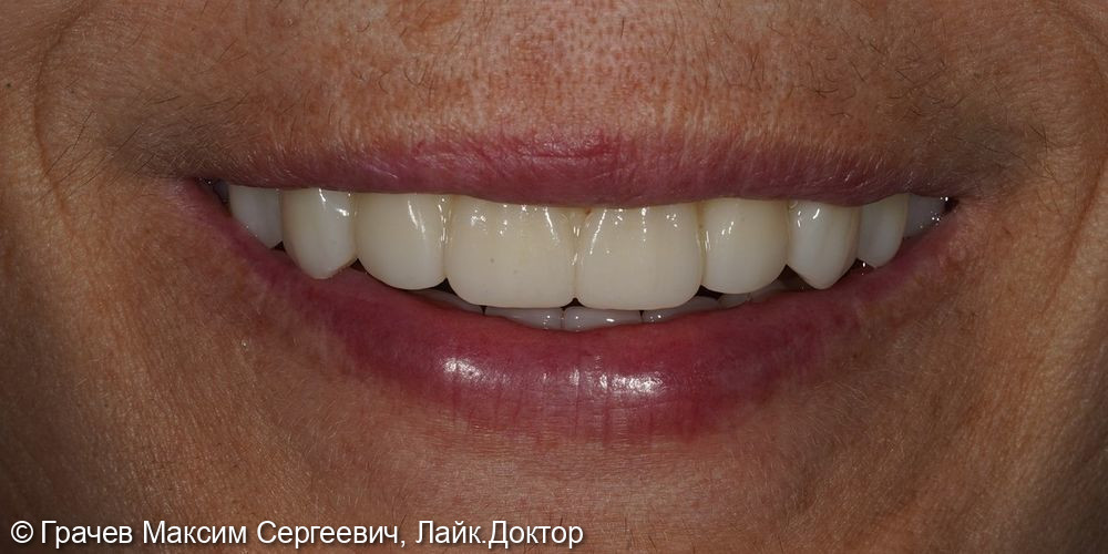 Несъемное протезирование при полном отсутствии зубов - фото №6