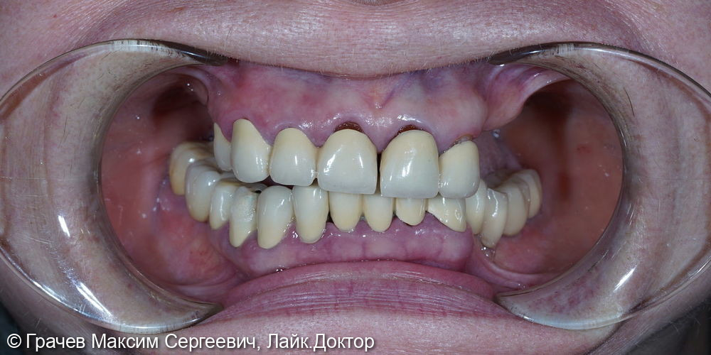 Все зубы на 4 имплантатах Pro Arch Straumann - фото №1