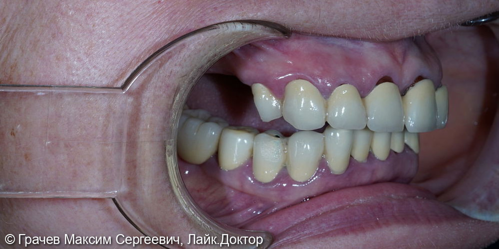 Все зубы на 4 имплантатах Pro Arch Straumann - фото №2