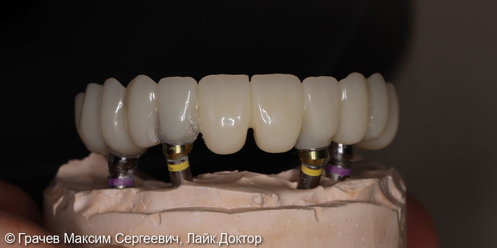 Все зубы на 4 имплантатах Pro Arch Straumann - фото №4