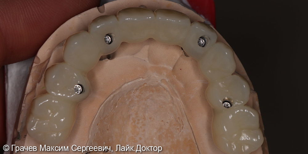 Все зубы на 4 имплантатах Pro Arch Straumann - фото №5