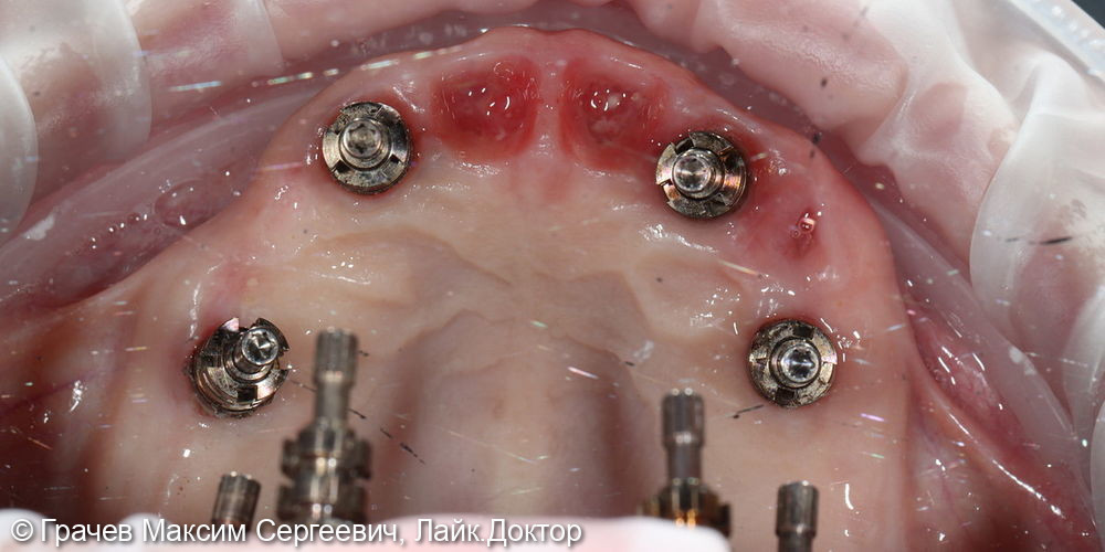 Все зубы на 4 имплантатах Pro Arch Straumann - фото №6