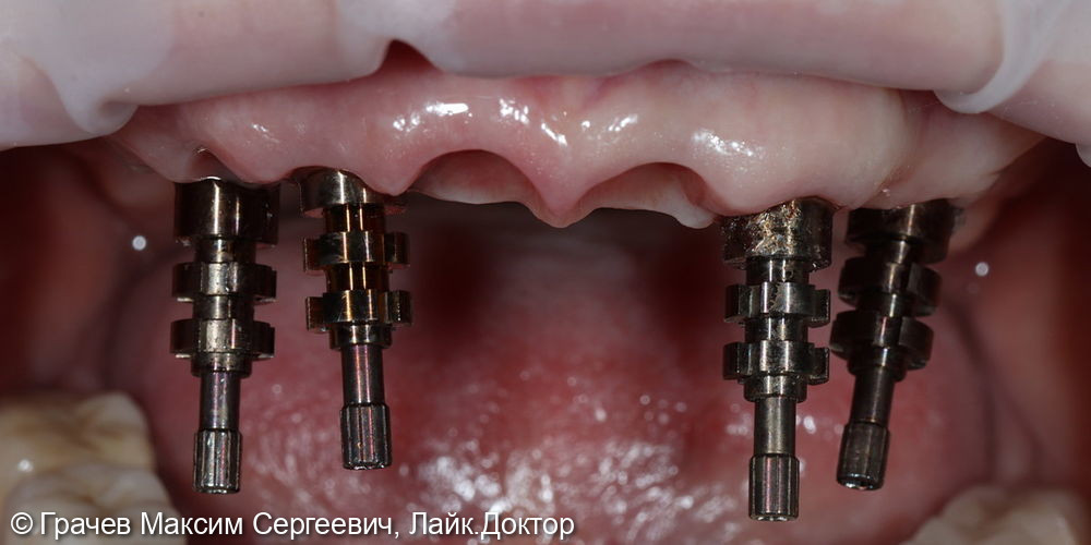 Все зубы на 4 имплантатах Pro Arch Straumann - фото №7