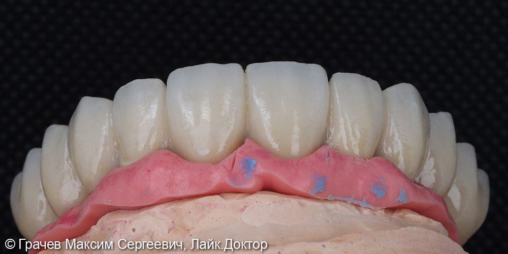 Все зубы на 4 имплантатах Pro Arch Straumann - фото №8