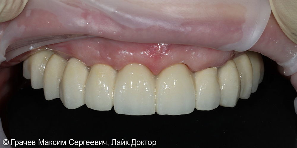 Все зубы на 4 имплантатах Pro Arch Straumann - фото №9
